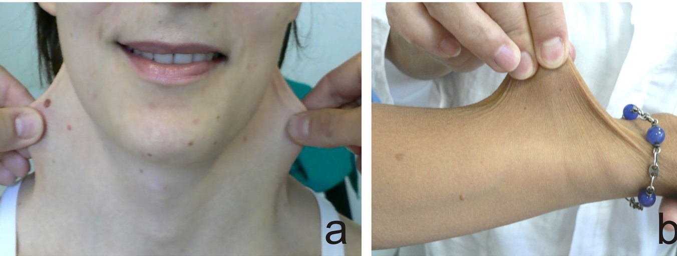 LA ACTUALIZACION DEL DIAGNÓSTICO REAL DEL SÍNDROME DE EHLERS DANDLOS