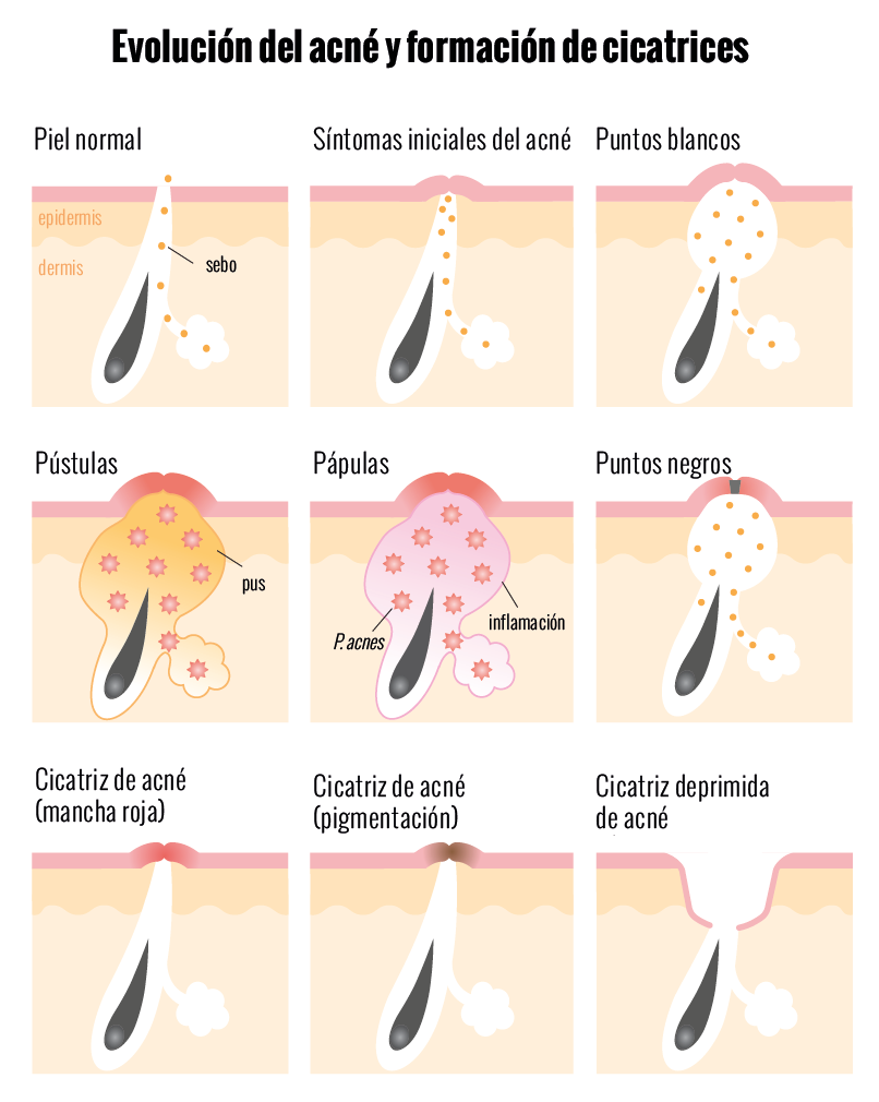 Formacin-del-acne.png
