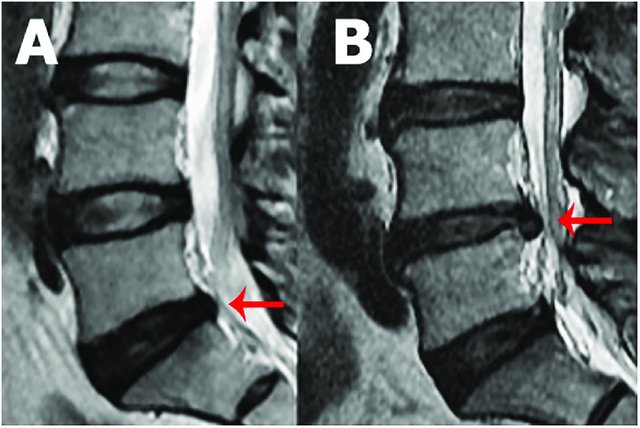 Sagittal-MRI-of-the-lumbar-spine-showing-disc-protrusion-at-L5-S1-A-and-disc-extrusion_W640.jpg
